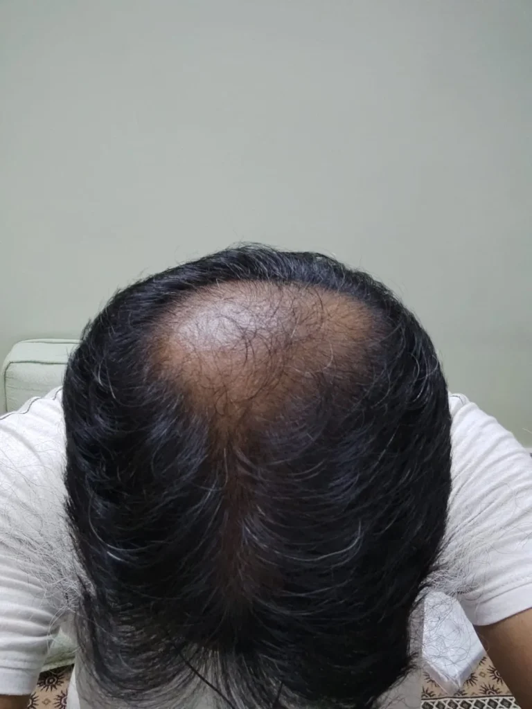 Regrowth after 90 days using Regenera Hair Oil with Rosemary