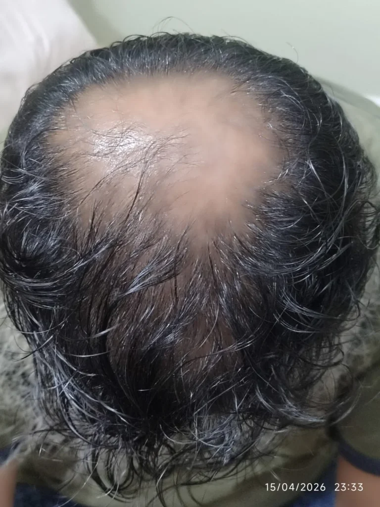 Before Regenera Hair Oil – hair thinning and hair fall