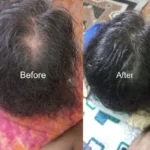 Regenera Hair Oil (Rosemary Growth Oil) - Before and after